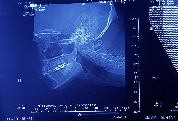 Human Skull X Ray Sideview Human Skull X Ray Sideview including neck. metal fillings can clearly be seen in the patient